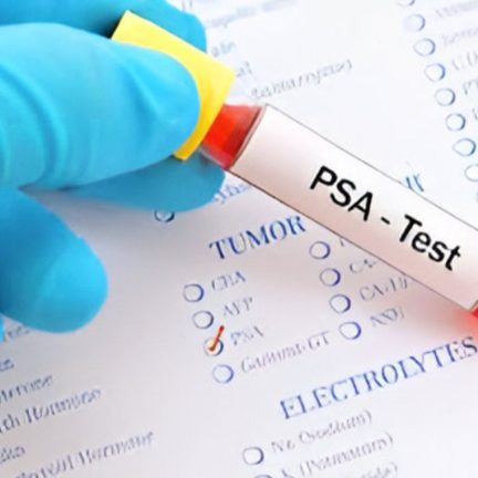 前列腺特異抗原檢查（PSA）