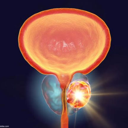 前列腺癌局部定位治療