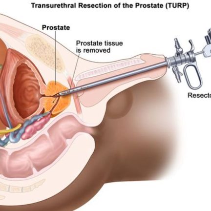經尿道前列腺切除術（TURP）