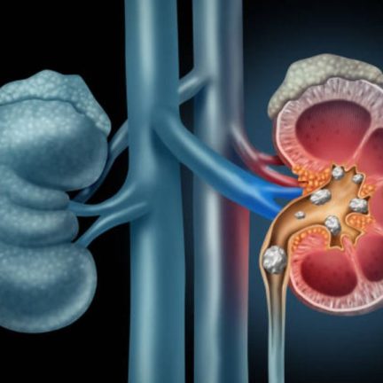 腎臟、輸尿管、膀胱結石