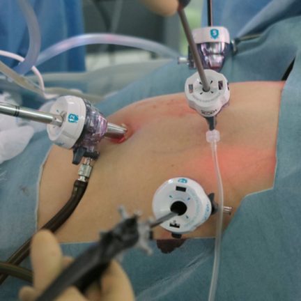 腹腔鏡手術（Laparoscopy）
