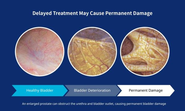 Delayed treatment may lead to permanent bladder damage.