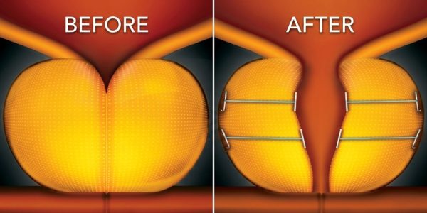 Before and After Comparison