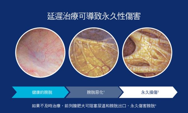 良性前列腺增生若未及時處理，前列腺組織會持續壓迫尿道，膀胱需長期過度用力排尿