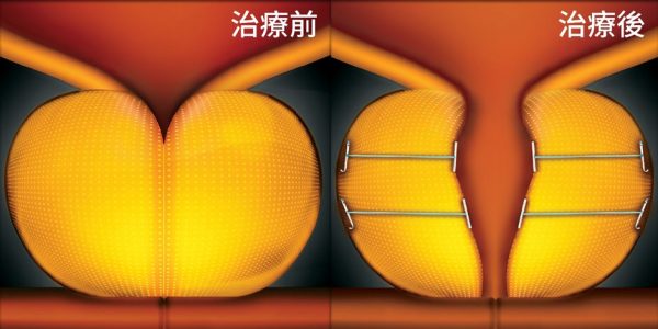 治療前後示意圖