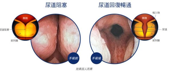 治療前後示意圖